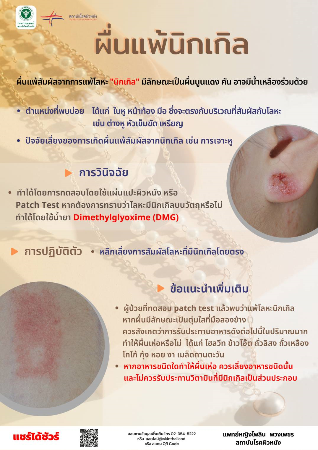 ผื่นผิวหนังจากการแพ้นิกเกิล (Nickel)