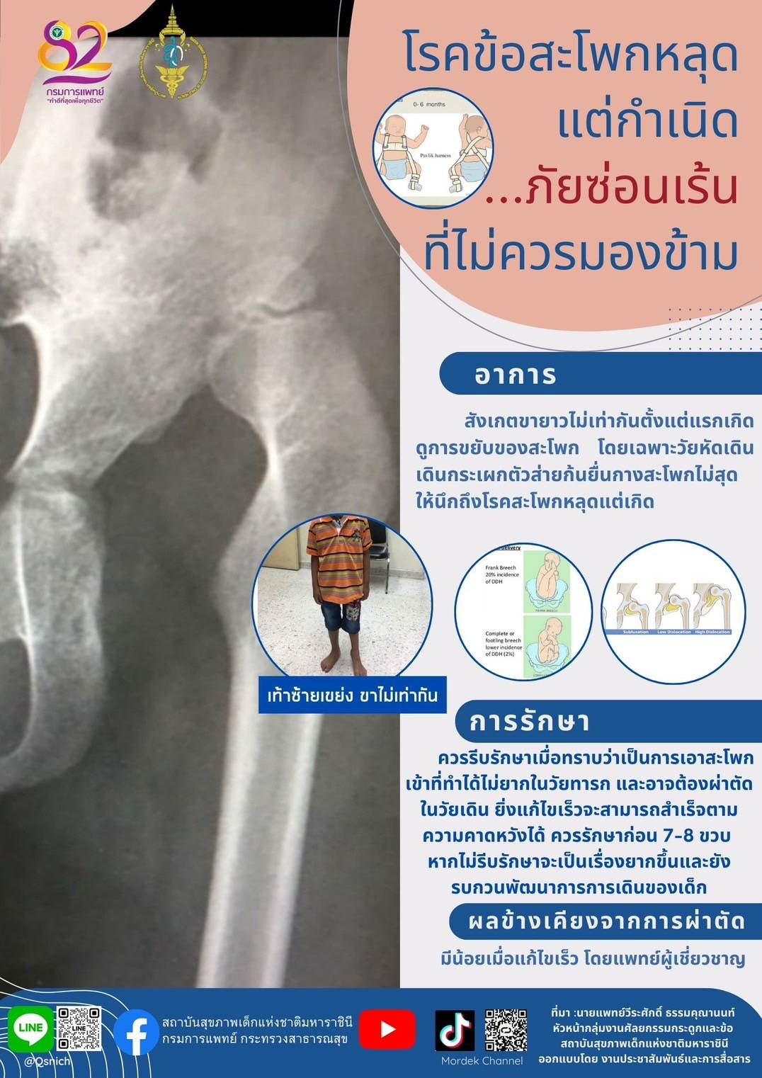 โรคข้อสะโพกหลุดแต่กำเนิด..ภัยซ่อนเร้นที่ไม่ควรมองข้าม