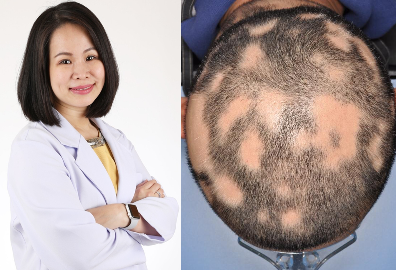ภาวะผมร่วงเป็นหย่อม (alopecia areata) คืออะไร ????