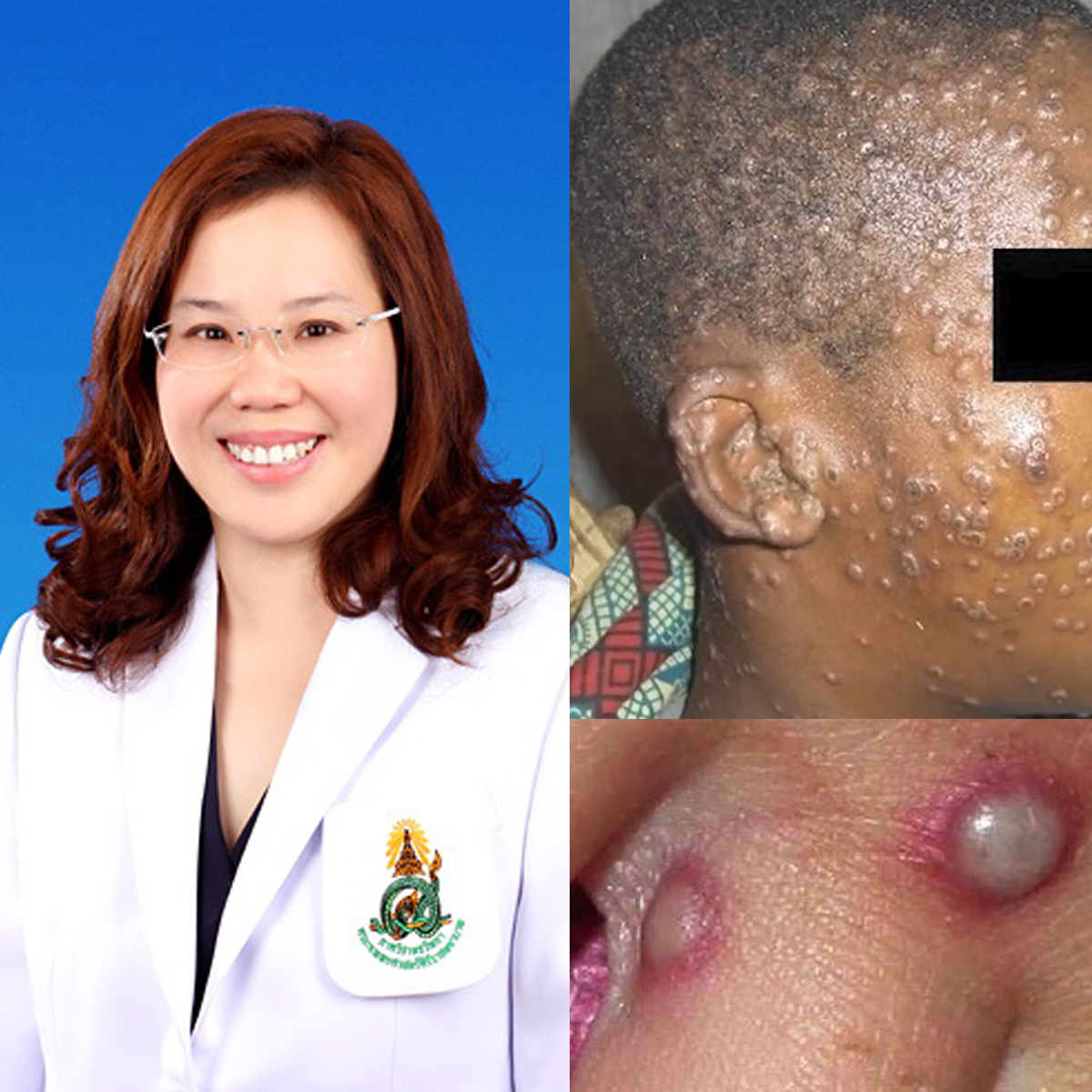 มารู้จักโรคฝีดาษลิง (monkeypox)