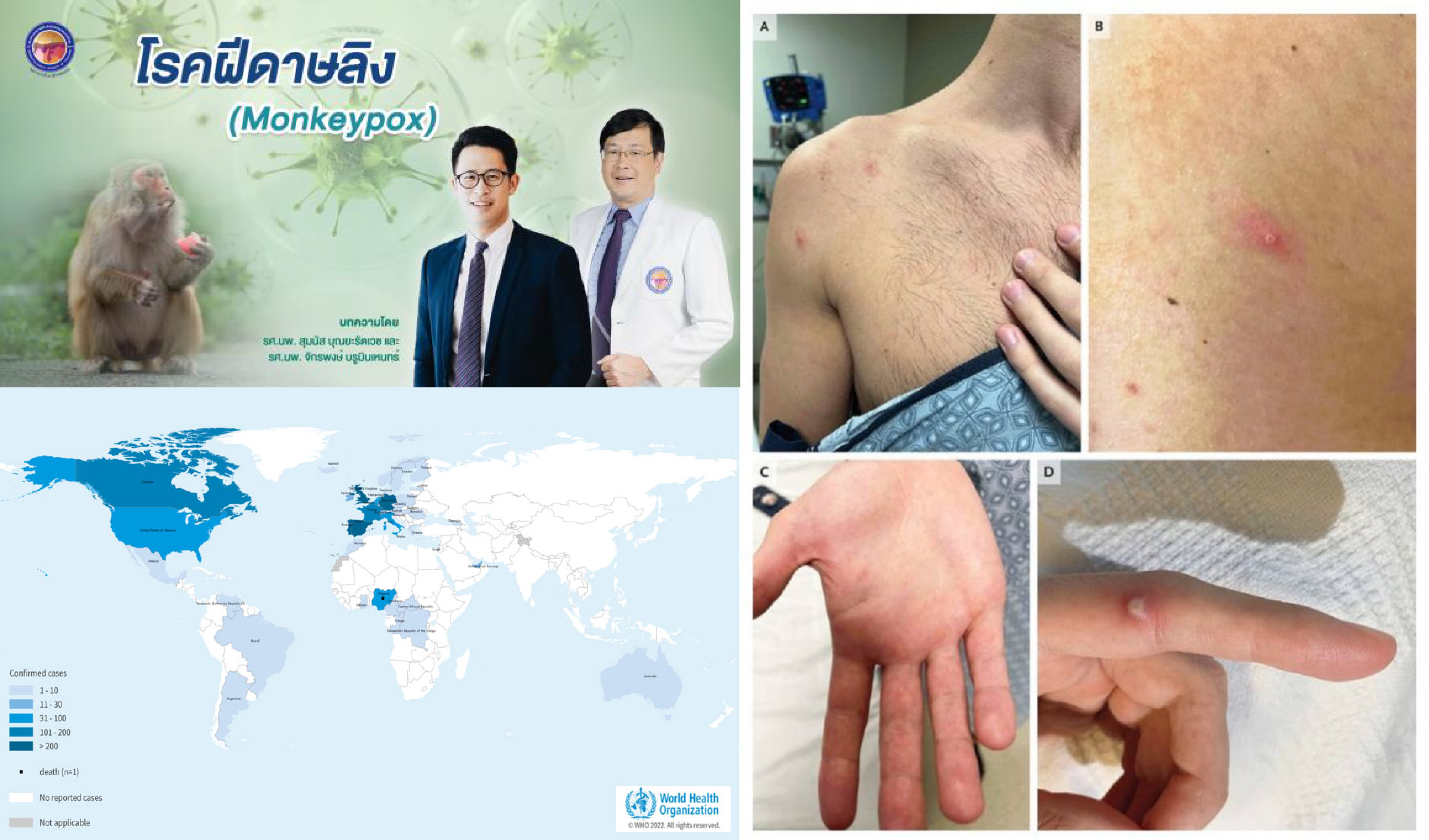 โรคฝีดาษลิงกับสถานการณ์โดยรวม