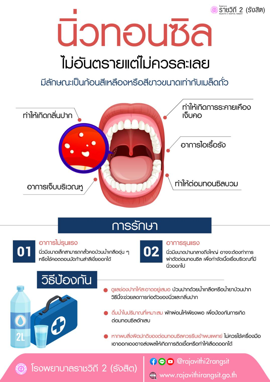 นิ่วทอนซิล ไม่อันตรายแต่ไม่ควรละเลย