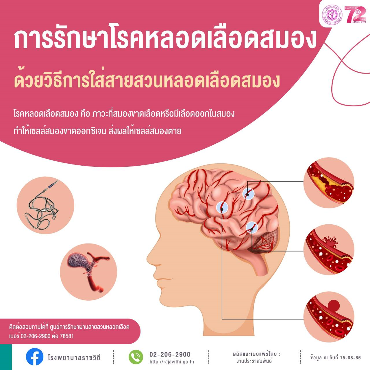 การรักษาโรคหลอดเลือดสมอง ด้วยวิธีการใส่สายสวนหลอดเลือดสมอง 
