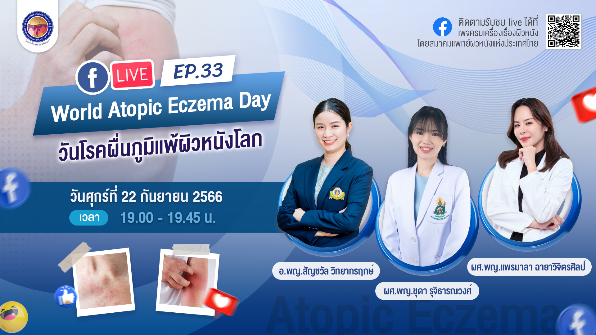 สมาคมแพทย์ผิวหนังฯ เชิญรับชมเพจเฟซบุ๊ก “ครบเครื่องเรื่องผิวหนัง” EP.33 ตอน “วันโรคภูมิแพ้ผิวหนังโลก”